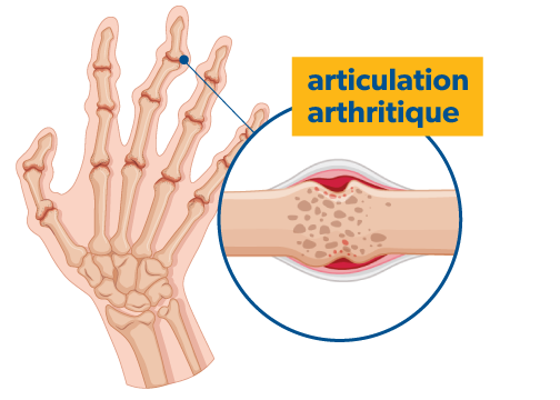 Main illustrée par ordinateur montrant des os et un gros plan sur l’articulation d’un doigt avec un os fusionné étiqueté « articulation arthritique ».